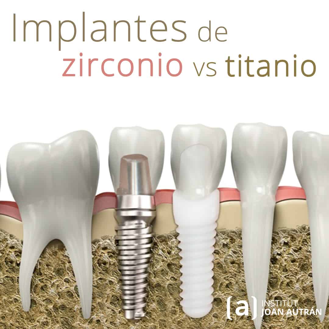 Implantes de Zirconio Qué son, Materiales, Imágenes, etc Institut Joan Autrán Implantes de Zirconio Qué son, Materiales, Imágenes, etc Institut Joan Autrán