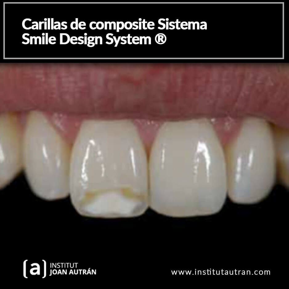 Información sobre las carillas dentales del Institut Joan Autrán